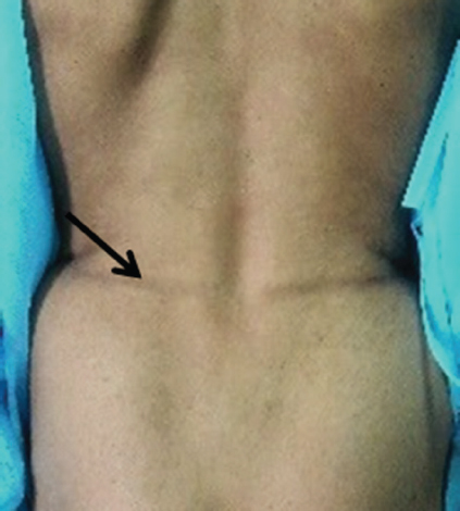 A groove sign (arrow).